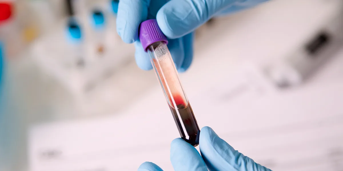 Krevní testy pro diagnostiku nízkého testosteronu